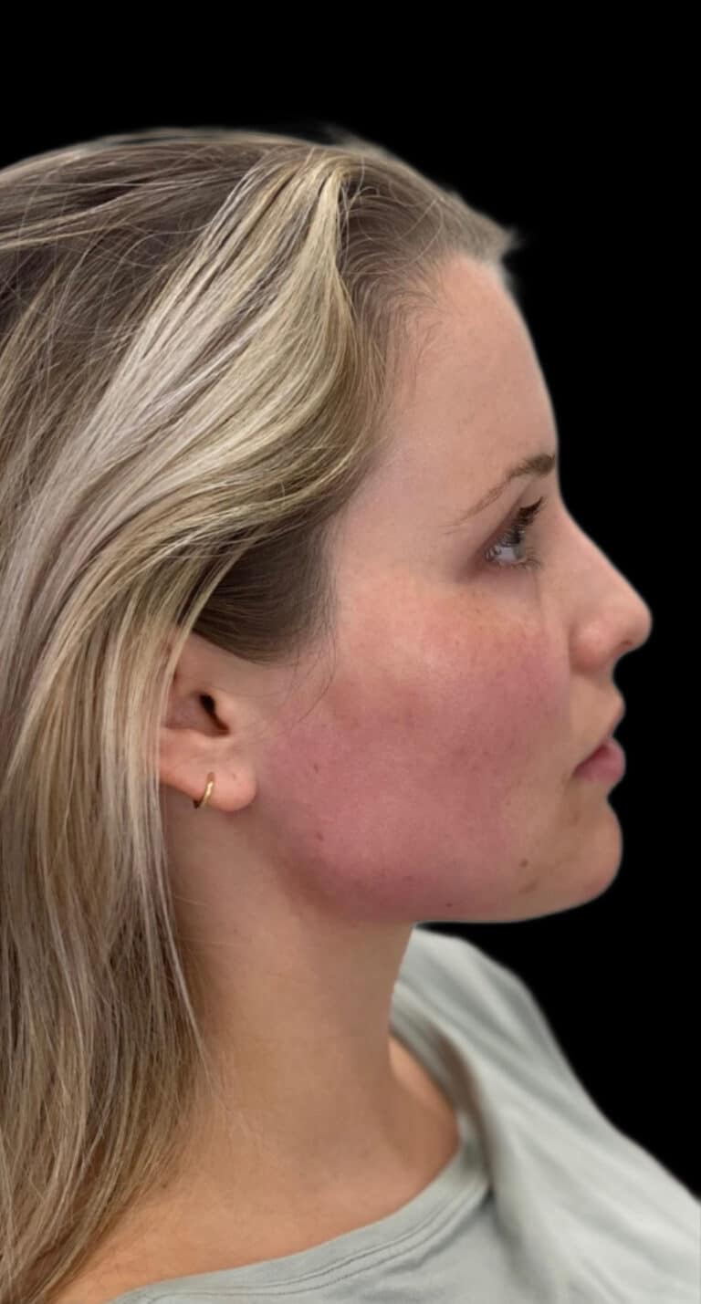 After Image: Jaw Line Filler - right-side