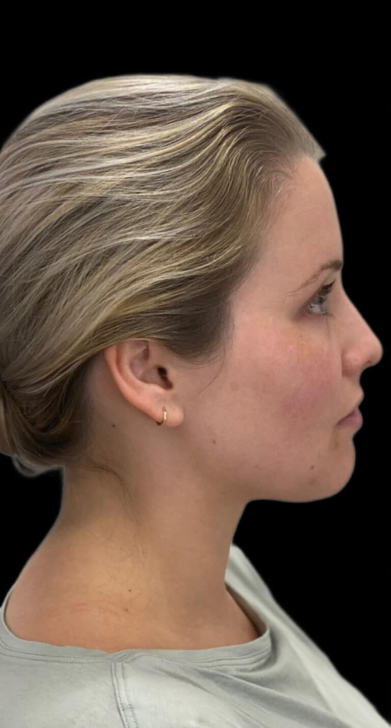 Before Image: Jaw Line Filler - right-side