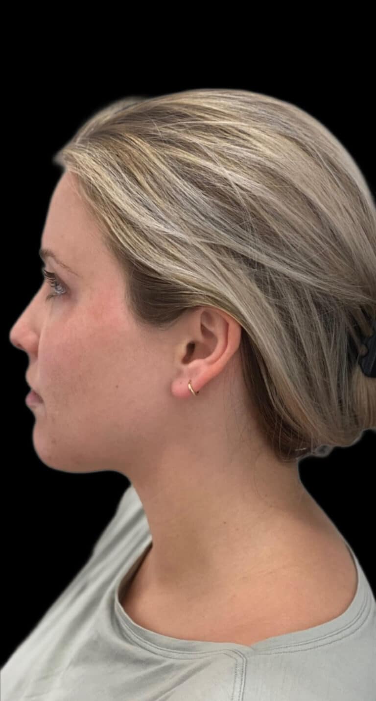 Before Image: Jaw Line Filler - left-side