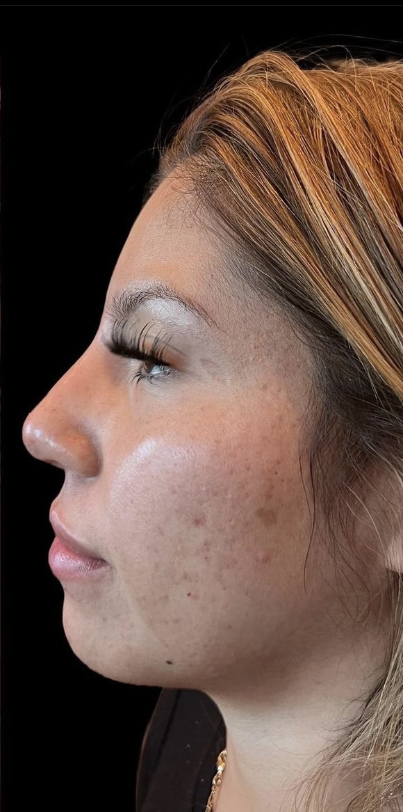 After Image: Liquid Rhinoplasty - left-side