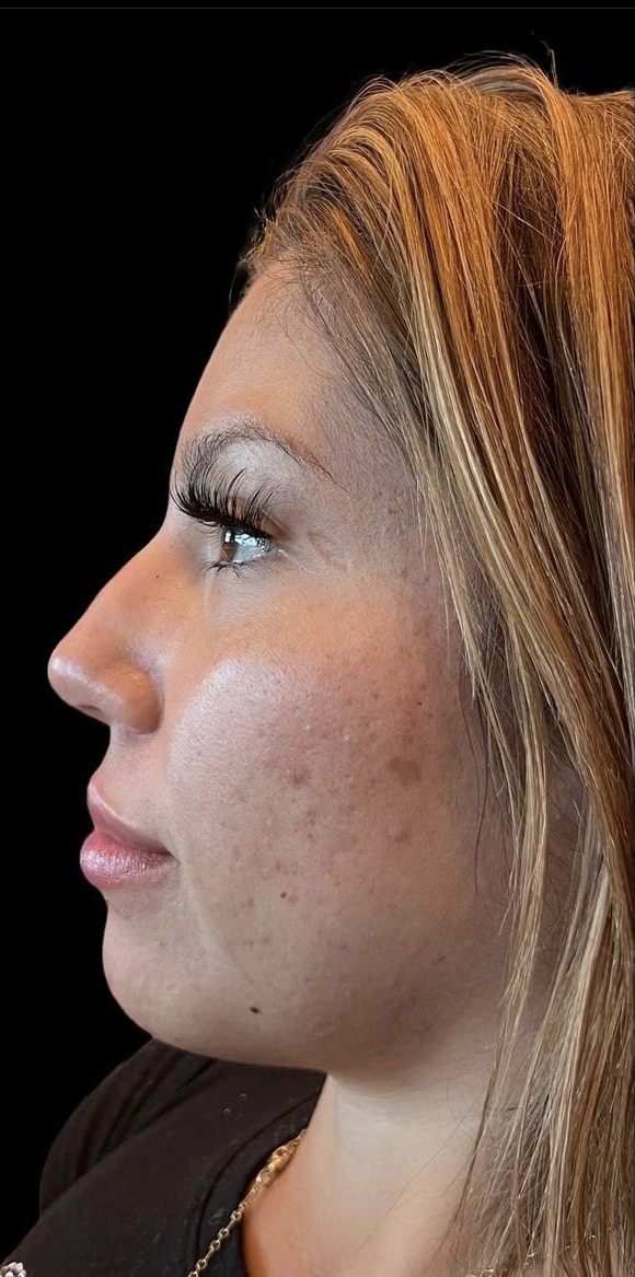 Before Image: Liquid Rhinoplasty - left-side