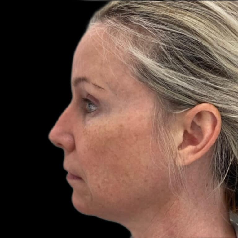 Before Image: Kybella - left-side