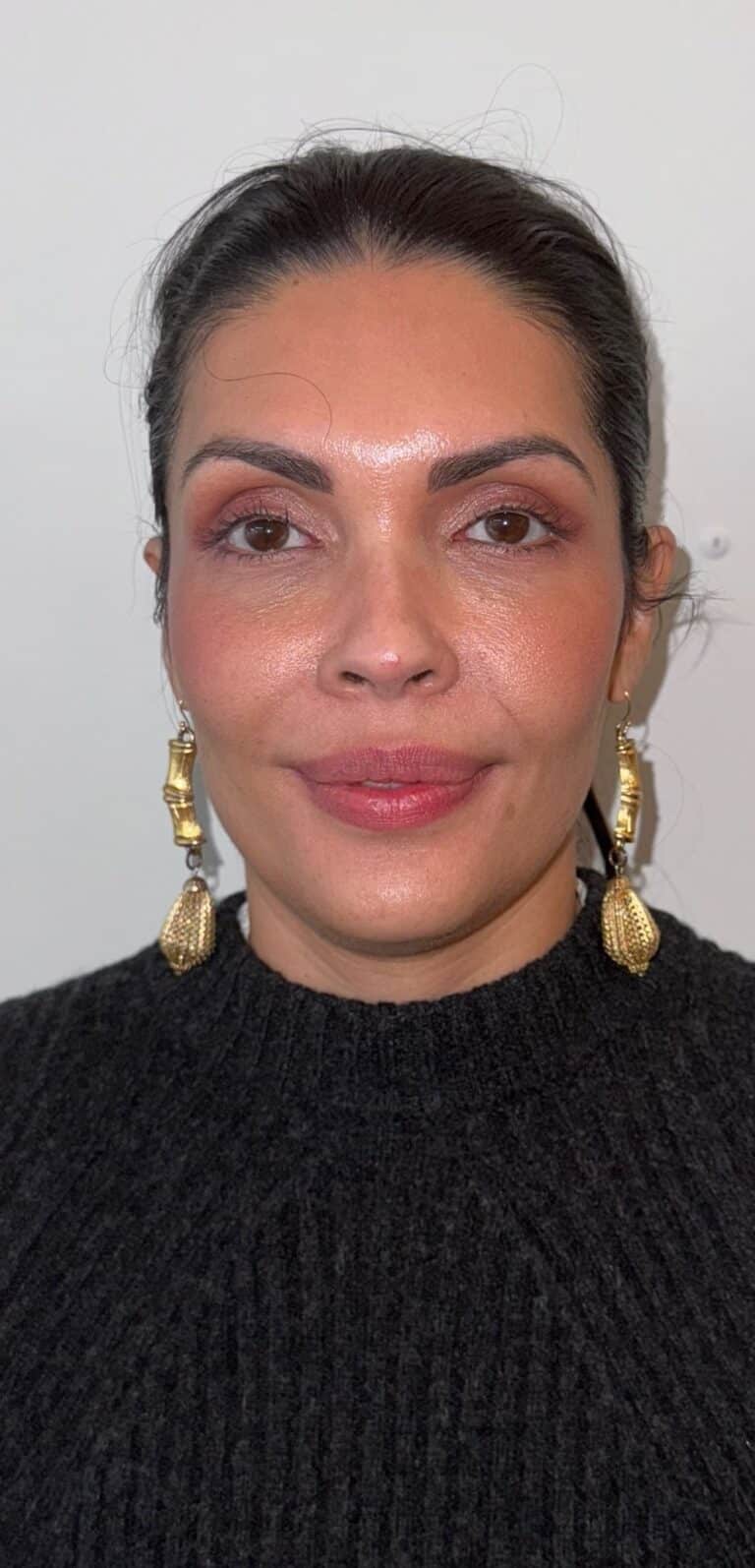 After Image: Botox Full Face - front