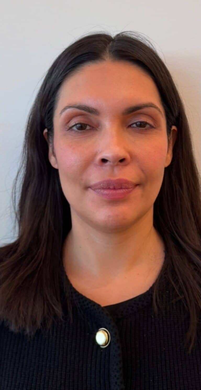 Before Image: Botox Full Face - front