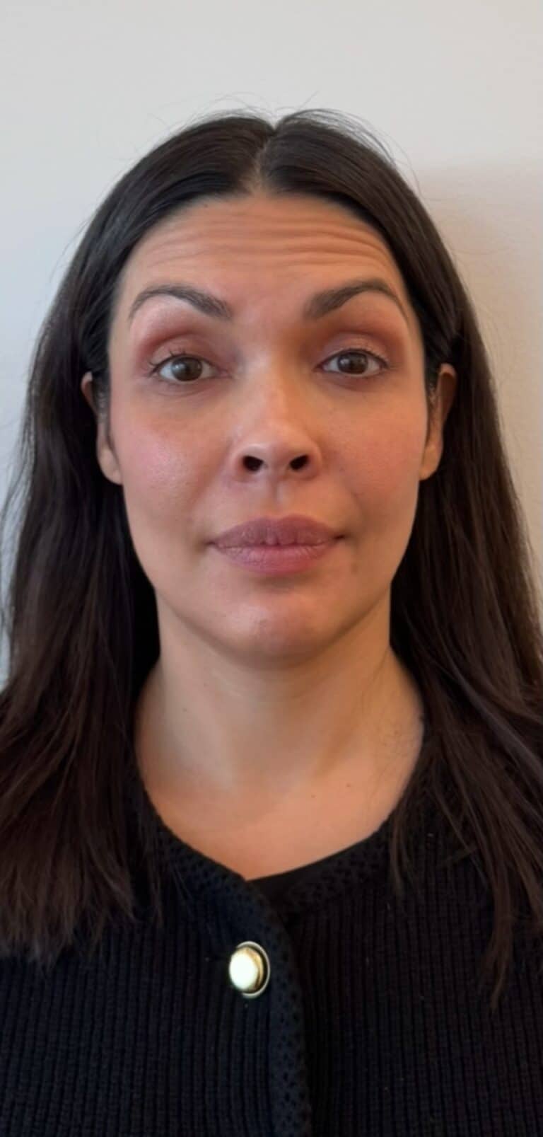 Before Image: Botox Full Face - front