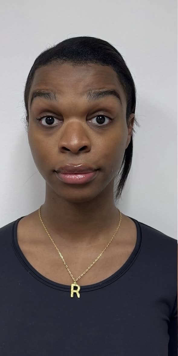 Before Image: Botox Full Face - front