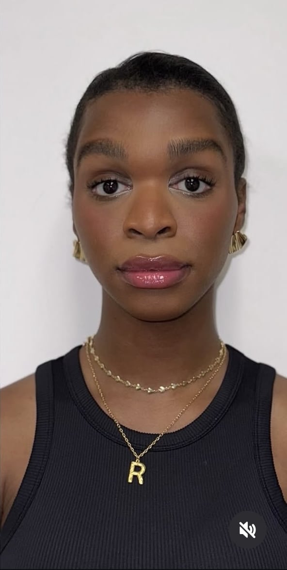 After Image: Botox Full Face - front