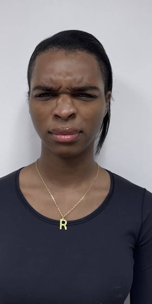 Before Image: Botox Full Face - front