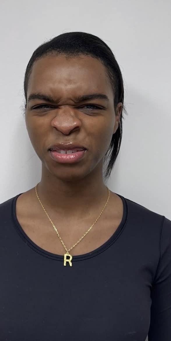 Before Image: Botox Full Face - front