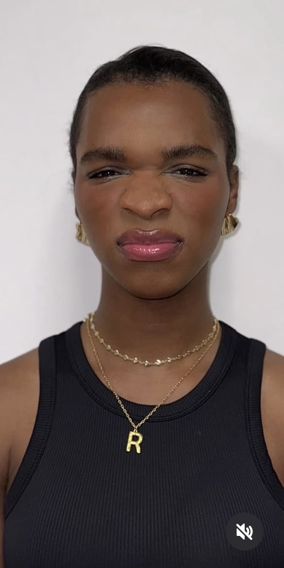 After Image: Botox Full Face - front