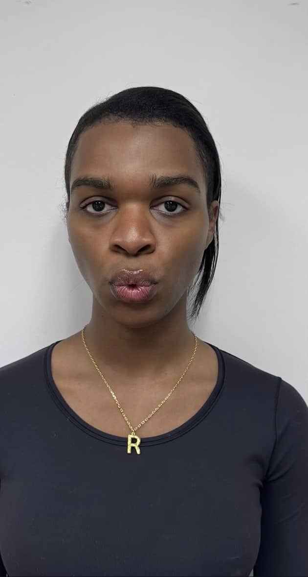 Before Image: Botox Full Face - front