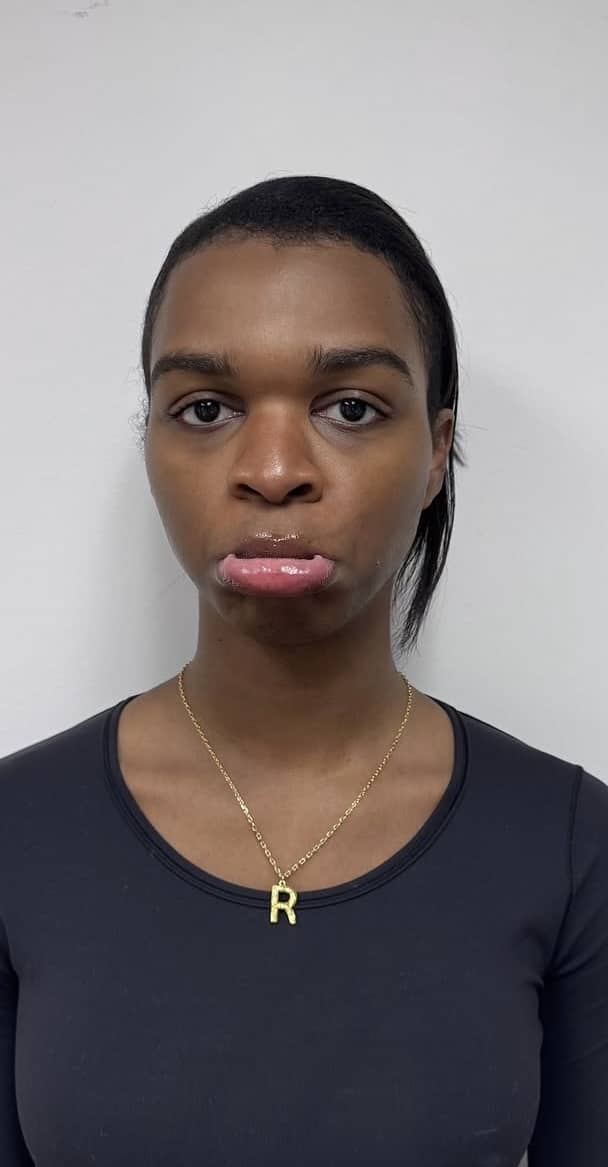 Before Image: Botox Full Face - front