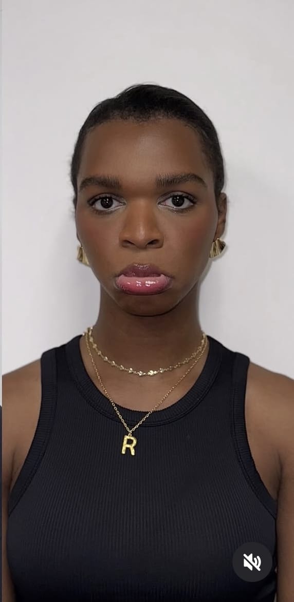 After Image: Botox Full Face - front