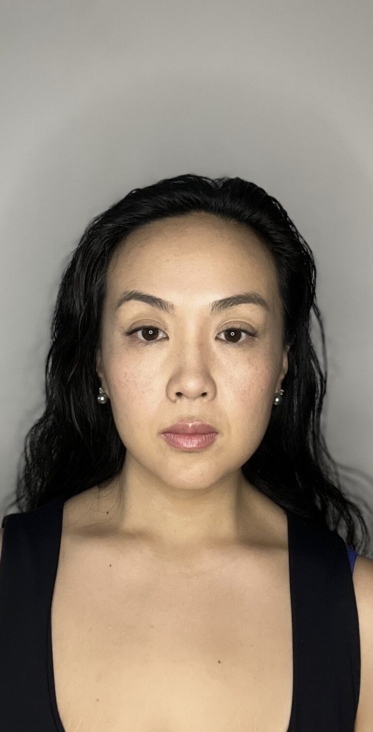 After Image: Botox Full Face - front