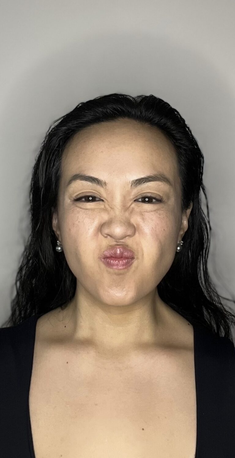 After Image: Botox Full Face - front