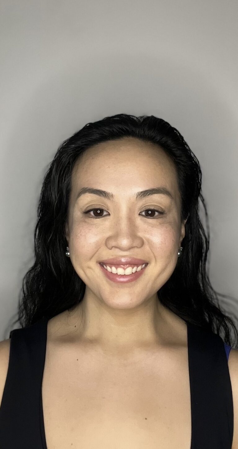 After Image: Botox Full Face - front