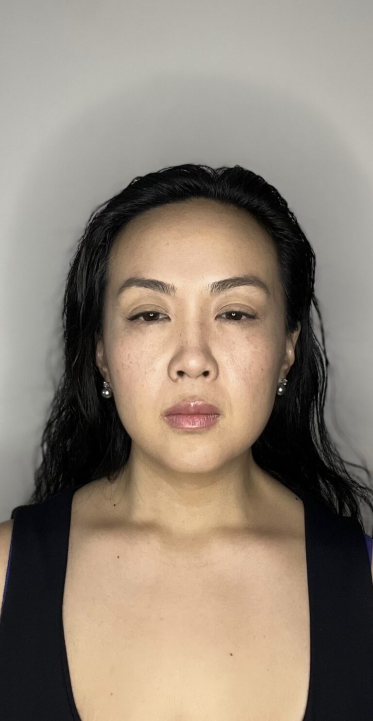 After Image: Botox Full Face - front