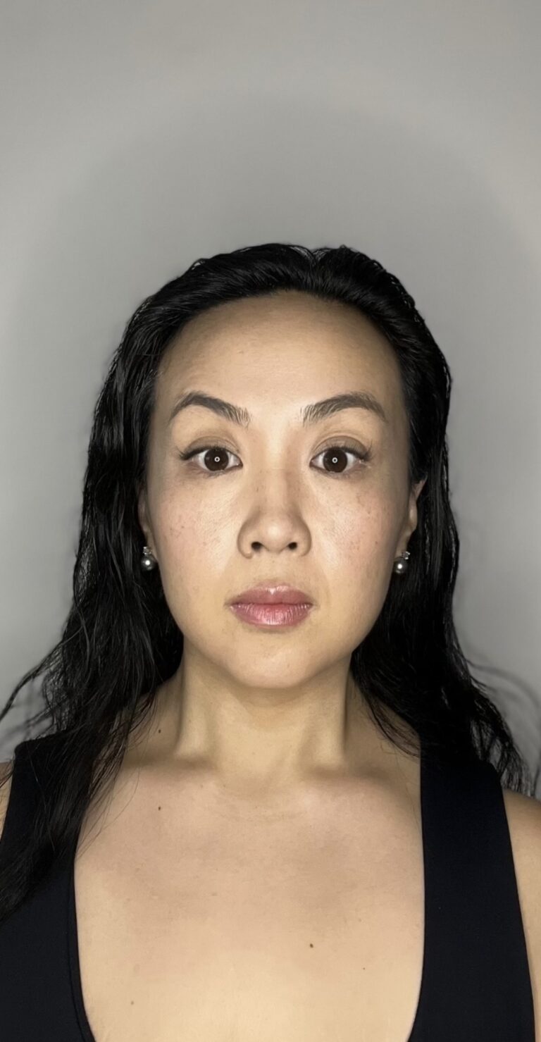 After Image: Botox Full Face - front