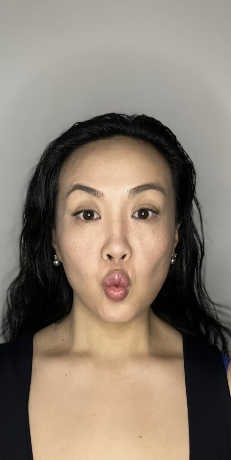 After Image: Botox Full Face - front
