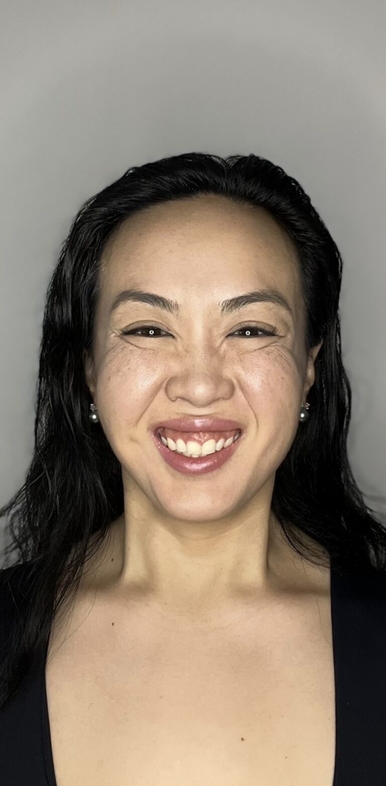 After Image: Botox Full Face - front