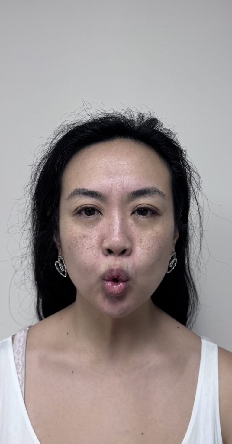 Before Image: Botox Full Face - front