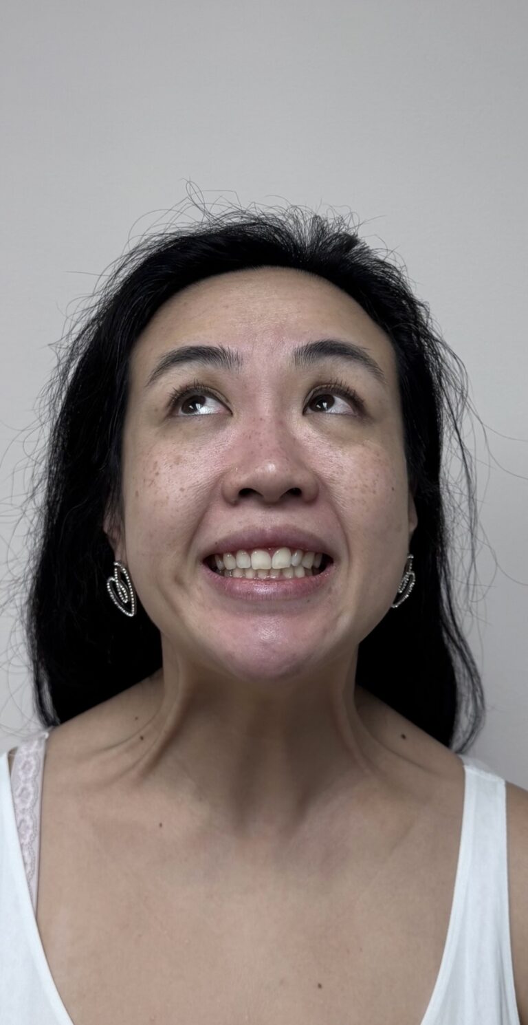 Before Image: Botox Full Face - front