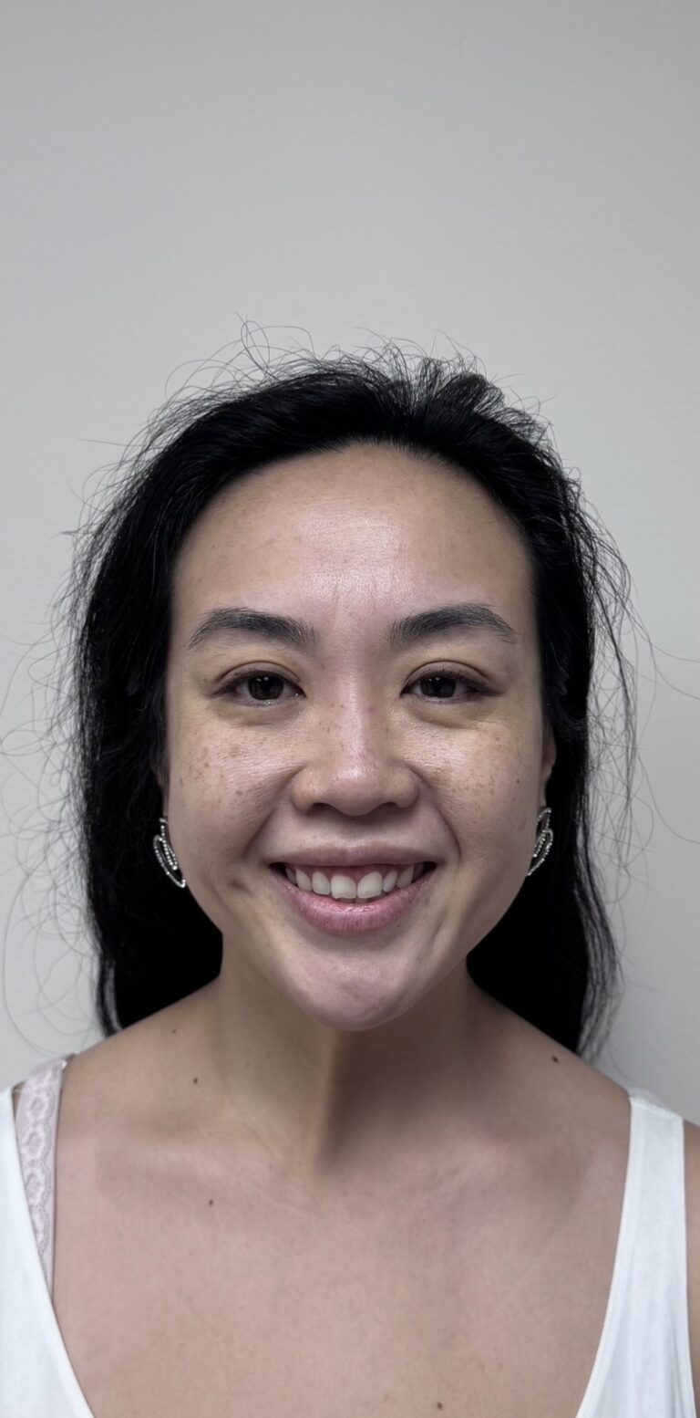 Before Image: Botox Full Face - front