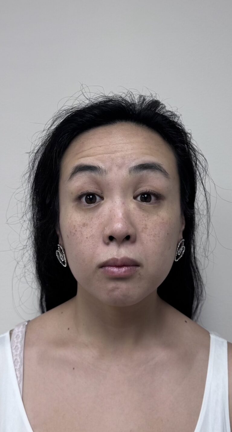 Before Image: Botox Full Face - front