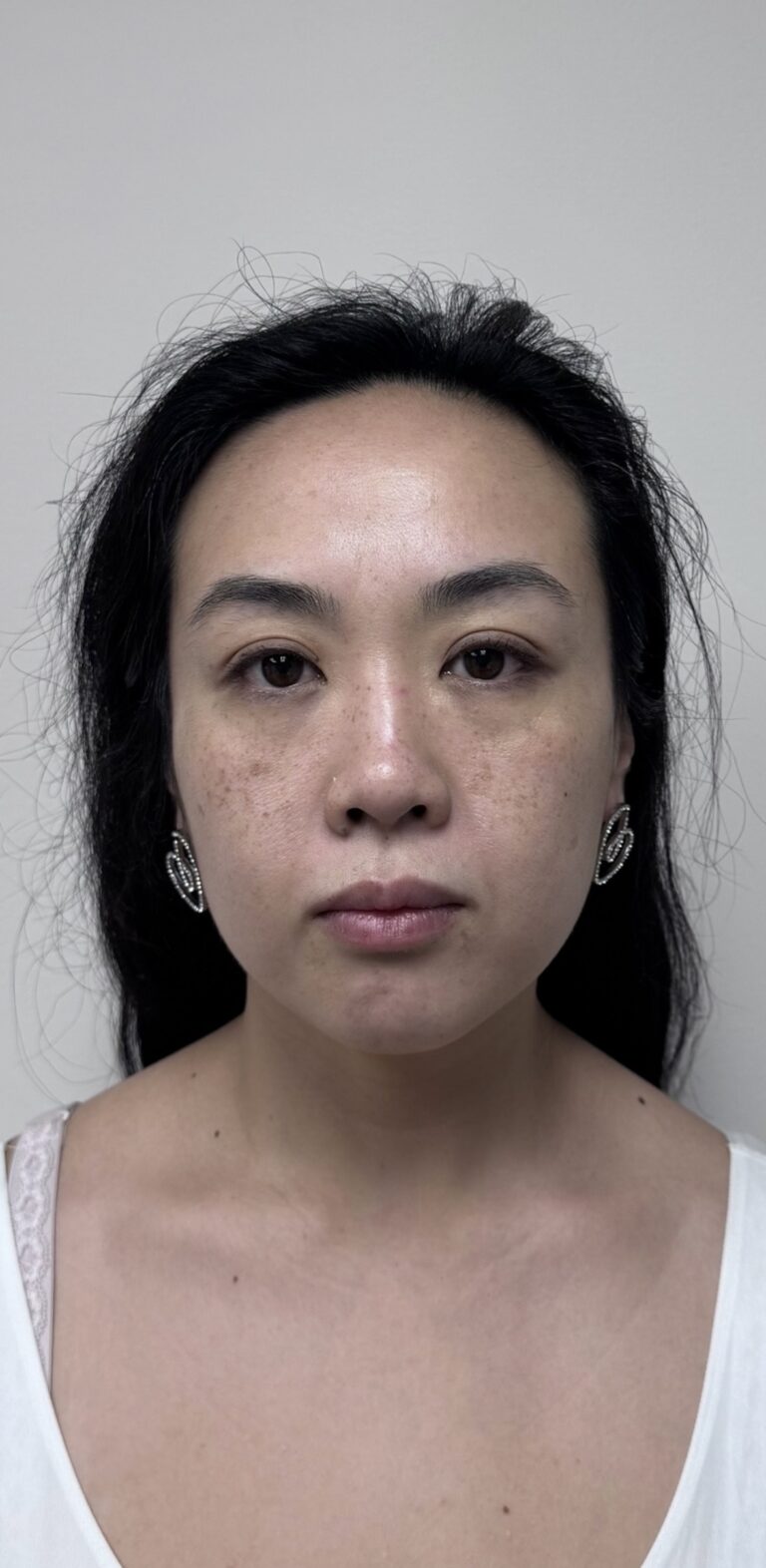 Before Image: Botox Full Face - front