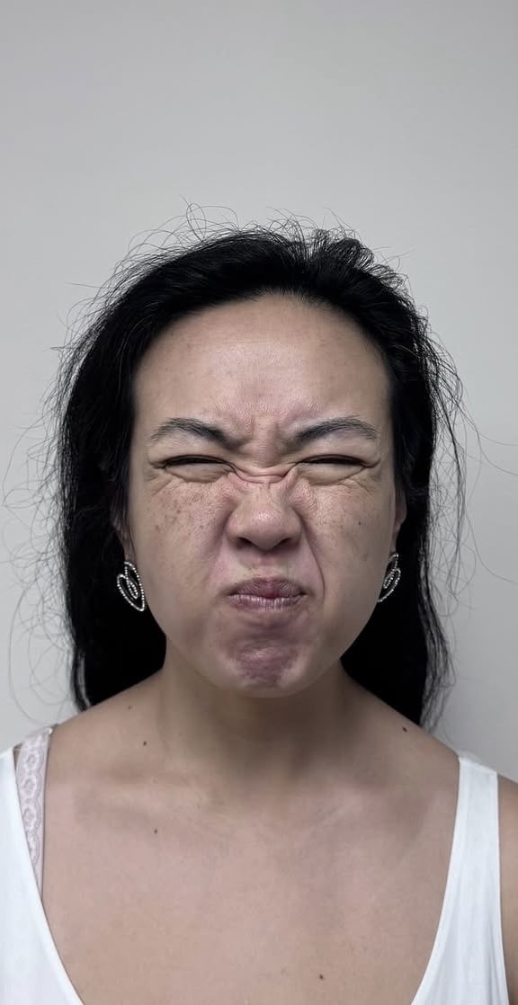 Before Image: Botox Full Face - front