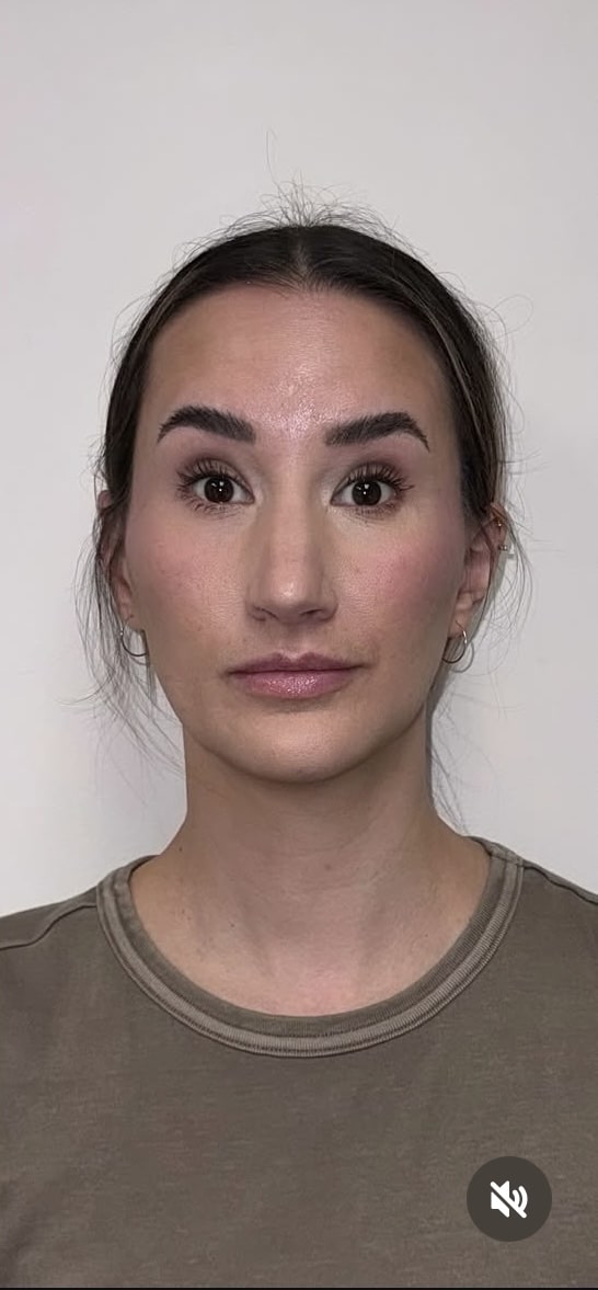 After Image: Botox Full Face - front