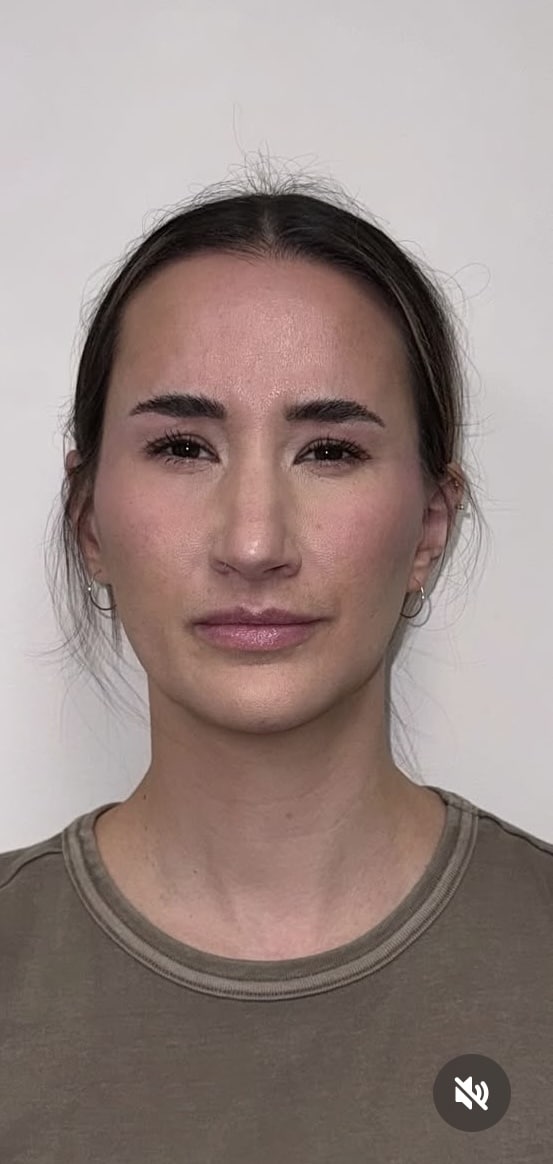 After Image: Botox Full Face - front