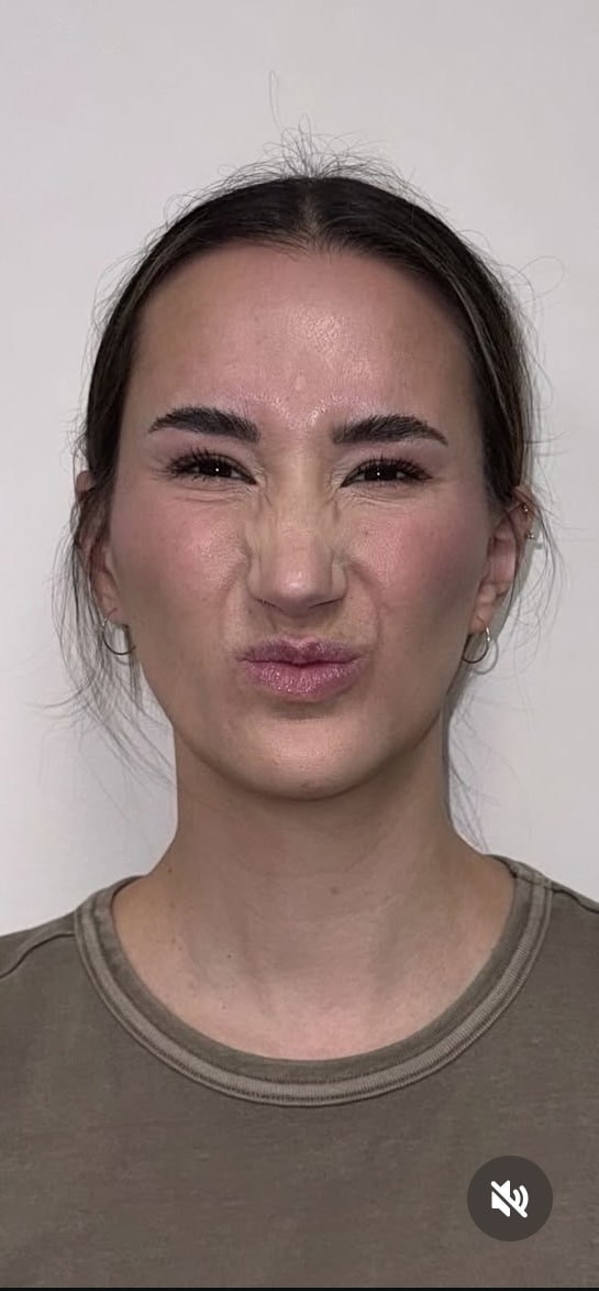 After Image: Botox Full Face - front