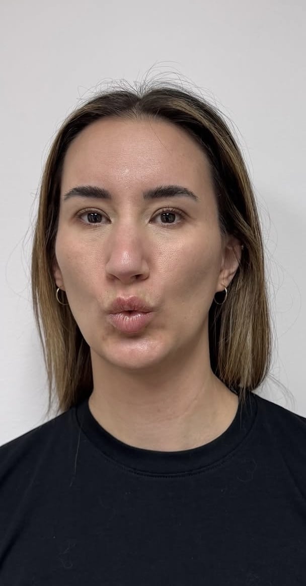 Before Image: Botox Full Face - front