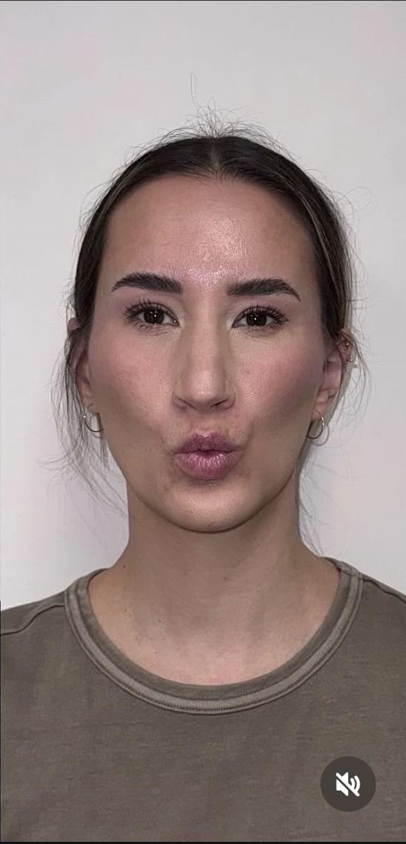 After Image: Botox Full Face - front